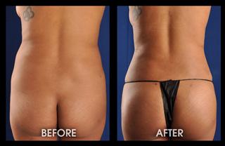 1-month-lipo-hips-fat-transfer-to-butt_Mobile
