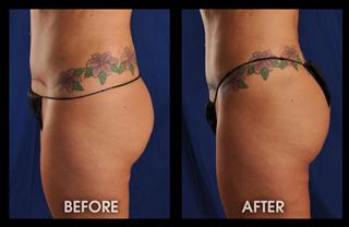 3-months-fat-transfer-and-lipo-hips_Mobile