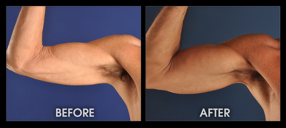 Tricep Implants - Male Muscle Augmentation