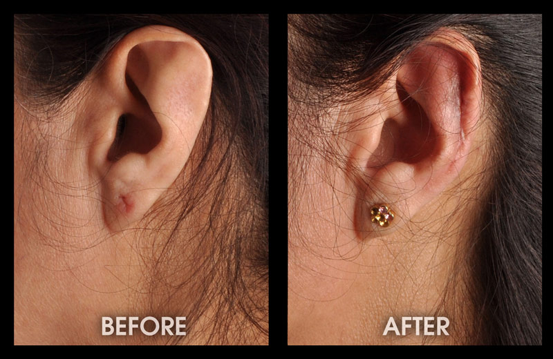 Ear Contouring Surgery | 2 weeks postop-creation-of-scapha-and-anti-helical-fold