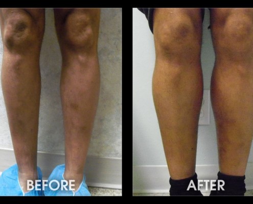 Calf Implants