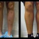 Calf Implants