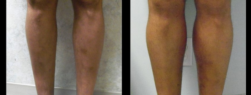 Calf Implants