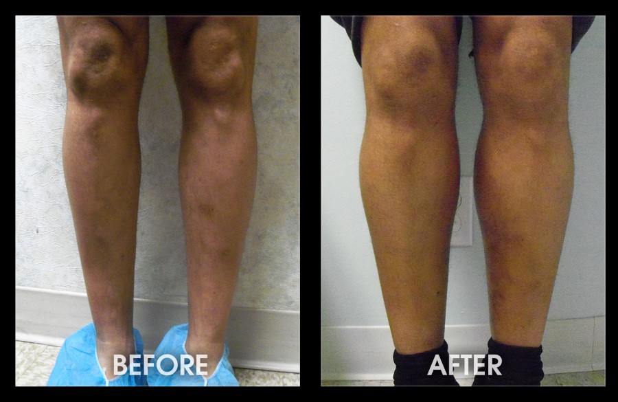 Calf Implants