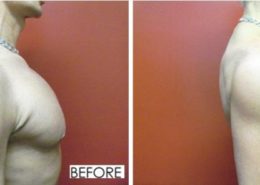 Implantes de deltoides masculinos antes y después
