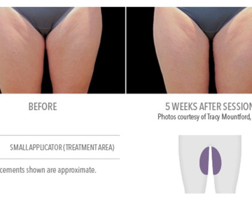 Coolsculpting Non-Surgical Fat Removal