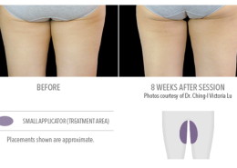 Coolsculpting Non-Surgical Fat Removal