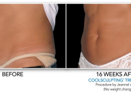 Coolsculpting Non-Surgical Fat Removal