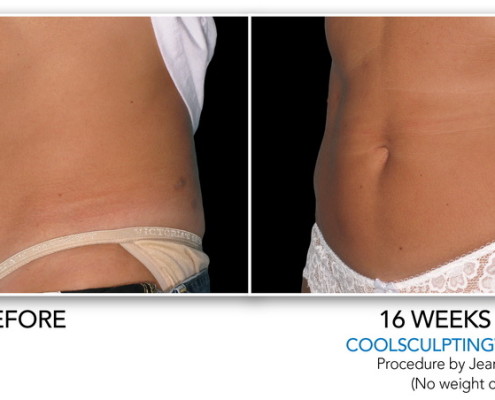 Coolsculpting Eliminación de grasa sin cirugía