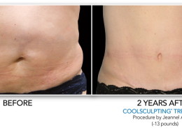 Coolsculpting Eliminación de grasa sin cirugía