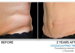 Coolsculpting Eliminación de grasa sin cirugía