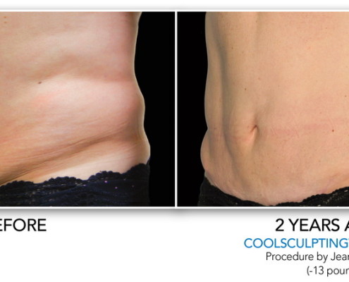 Coolsculpting Non-Surgical Fat Removal