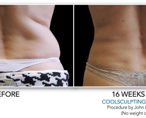 Coolsculpting Non-Surgical Fat Removal