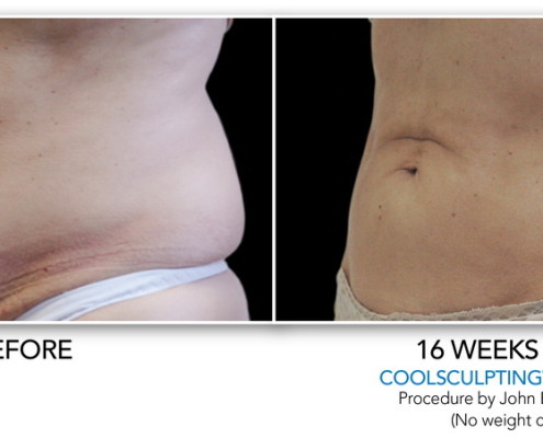 Coolsculpting Non-Surgical Fat Removal