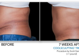 Coolsculpting Non-Surgical Fat Removal