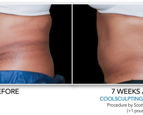 Coolsculpting Eliminación de grasa sin cirugía