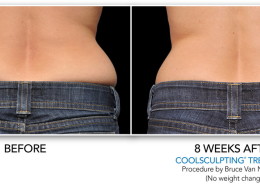 Coolsculpting Non-Surgical Fat Removal