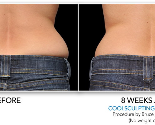 Coolsculpting Non-Surgical Fat Removal