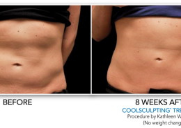 Coolsculpting Eliminación de grasa sin cirugía