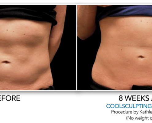 Coolsculpting Non-Surgical Fat Removal