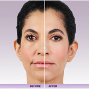 juvederm-xc-liz