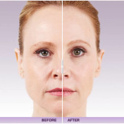 juvederm-xc-niffery