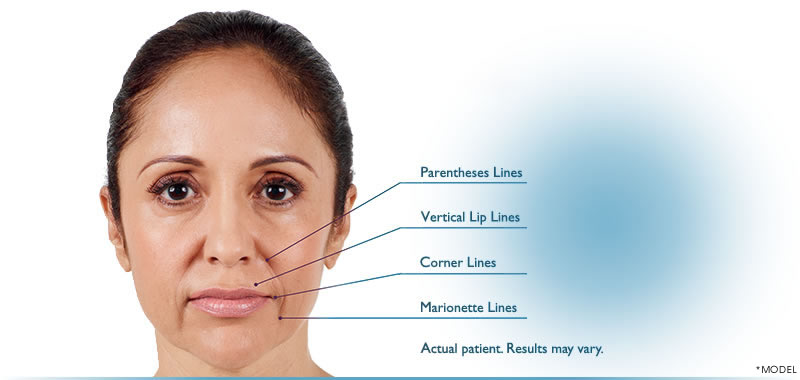 JUVÉDERM® XC is a gel filler that effectively smooths away wrinkles around your mouth and nose.