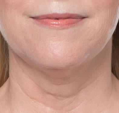 kybella-aging