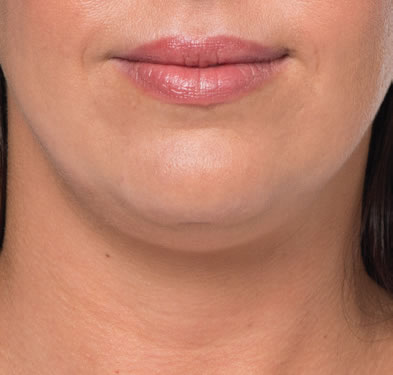 kybella-genetics