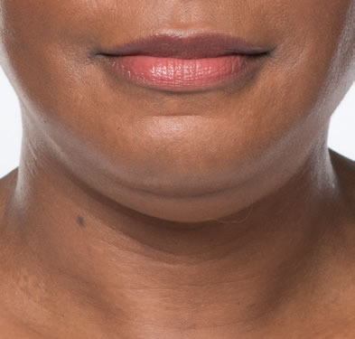 kybella-weight-gain