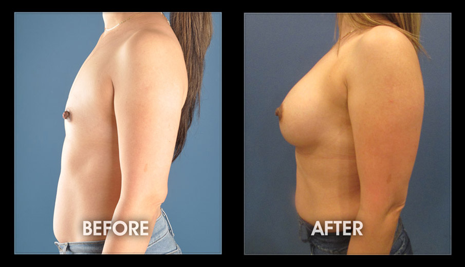 a comparison of a woman's breast before and after