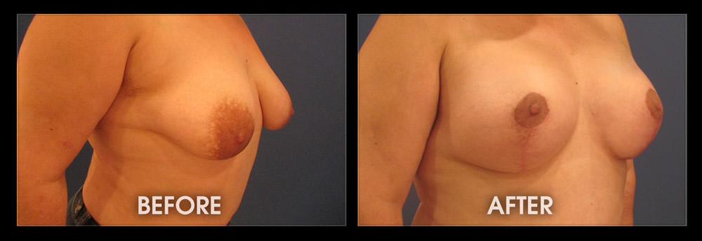 a comparison of a woman's breast