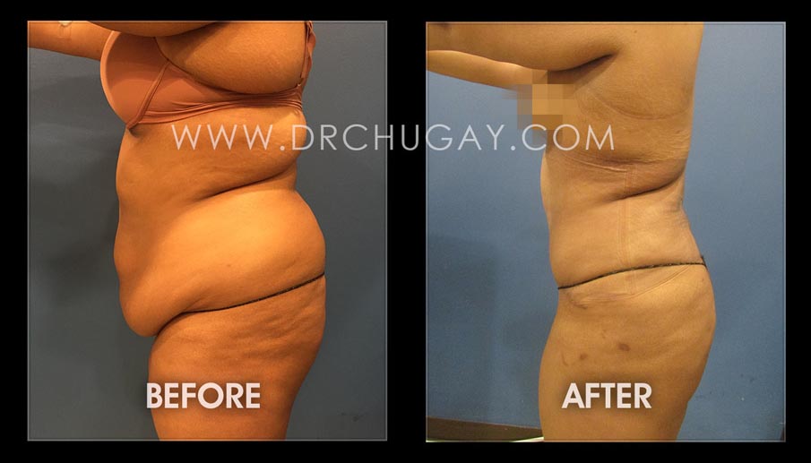 a woman's body before and after surgery