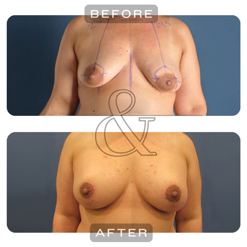 2024-Chugay---breast-surgery-before-after