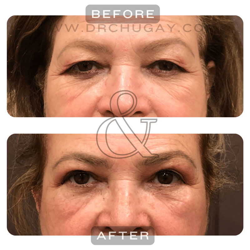 Chugay---upper-eye-surgery-before-after